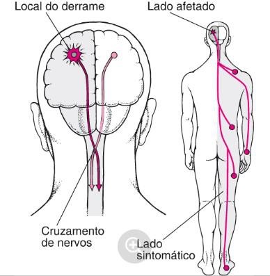 cruzamento de nervos