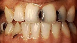 dentes estragados