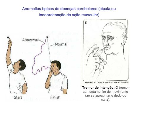 anomalias tipicas de doenças cerebelares